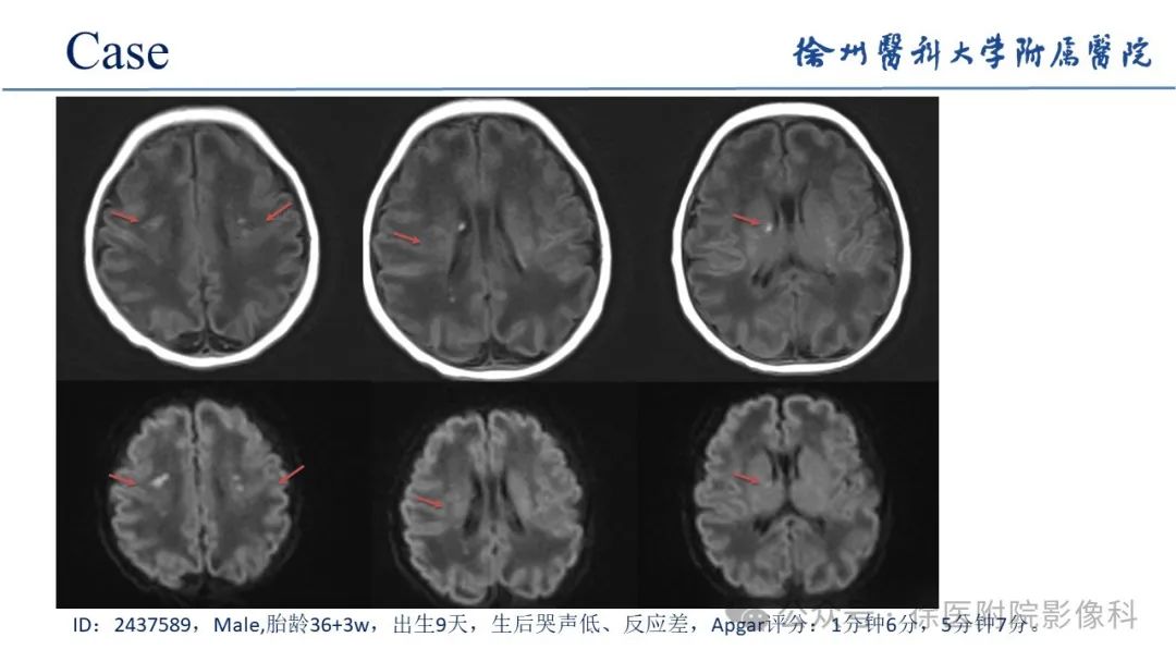 影像PPT - 【PPT】新生儿缺氧缺血性脑病-17
