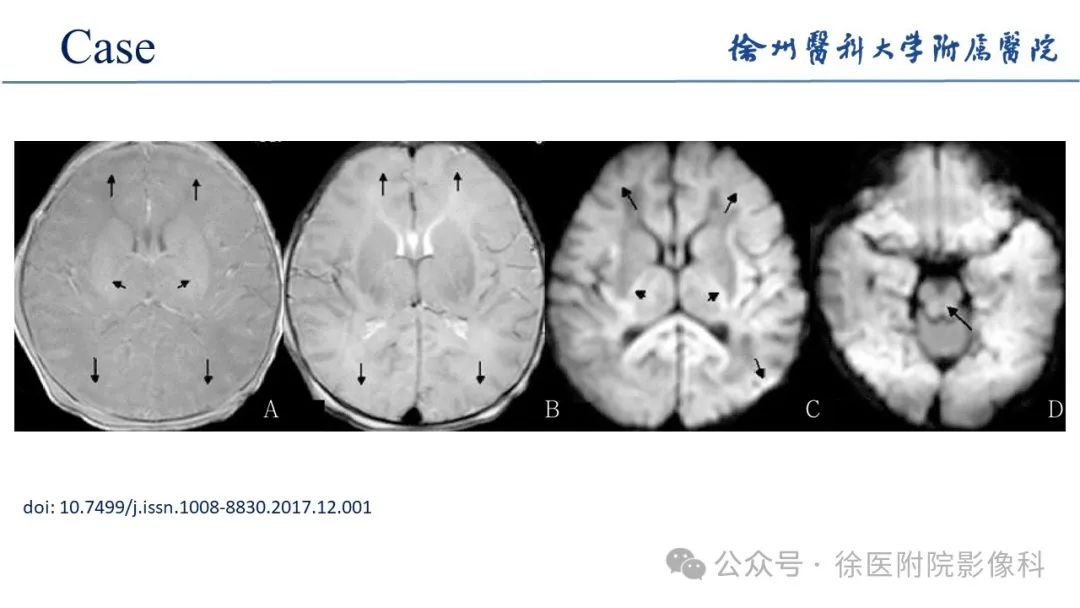 影像PPT - 【PPT】新生儿缺氧缺血性脑病-19