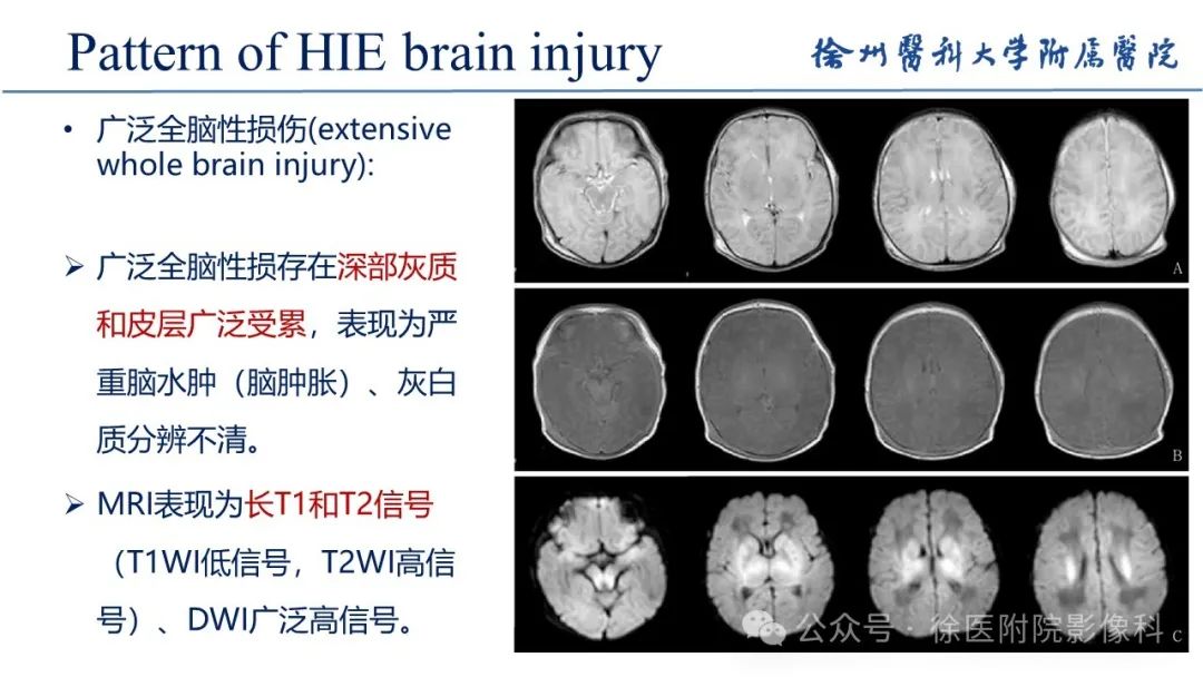 影像PPT - 【PPT】新生儿缺氧缺血性脑病-20