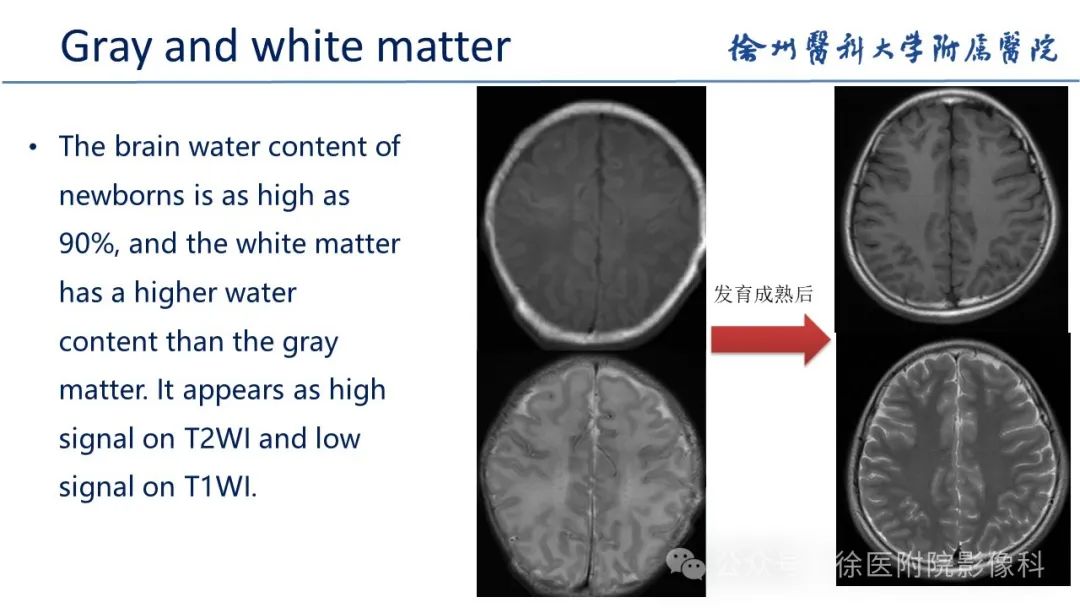 影像PPT - 【PPT】新生儿缺氧缺血性脑病-1