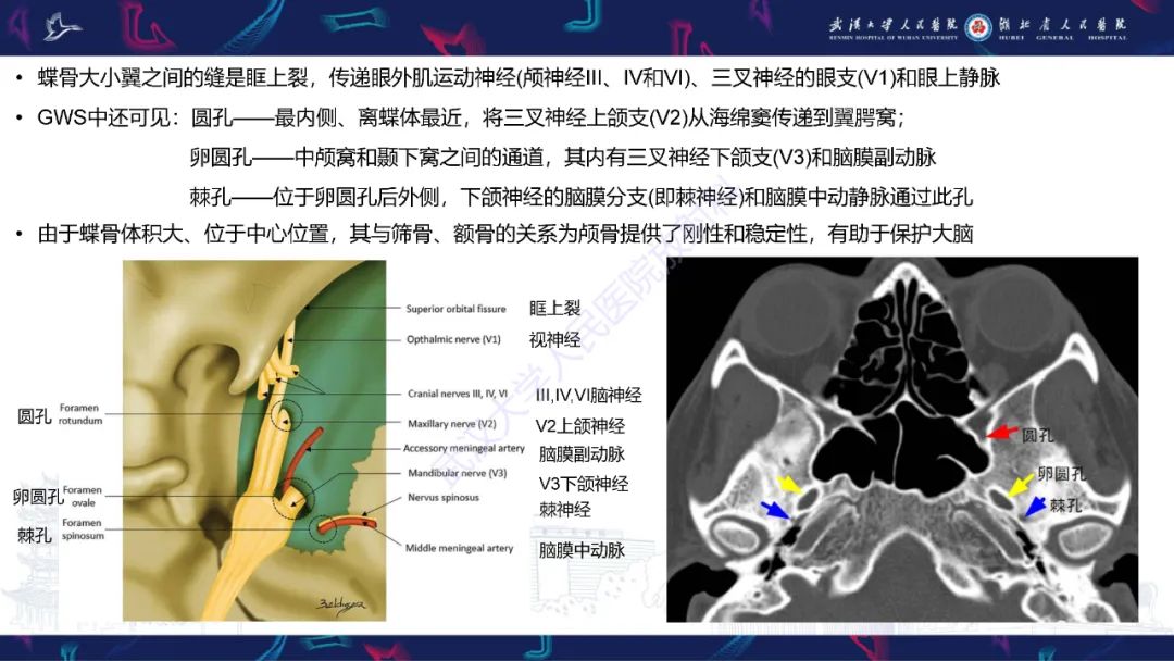 影像PPT - 【PPT】蝶骨大翼病变影像诊断-7