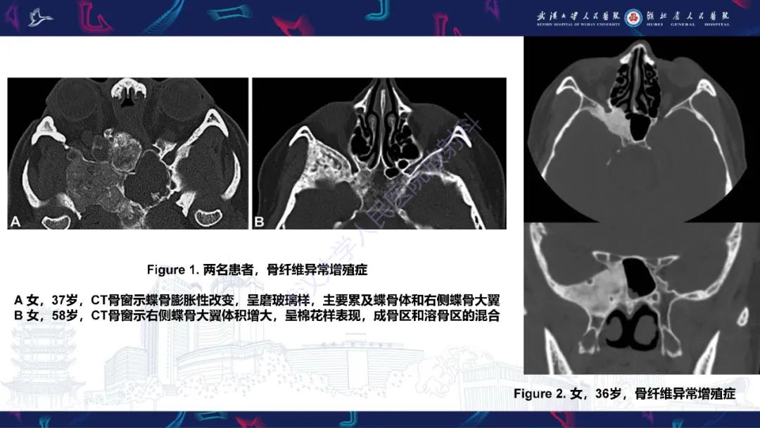 影像PPT - 【PPT】蝶骨大翼病变影像诊断-10