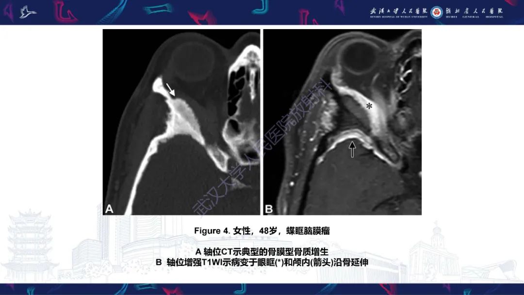 影像PPT - 【PPT】蝶骨大翼病变影像诊断-13