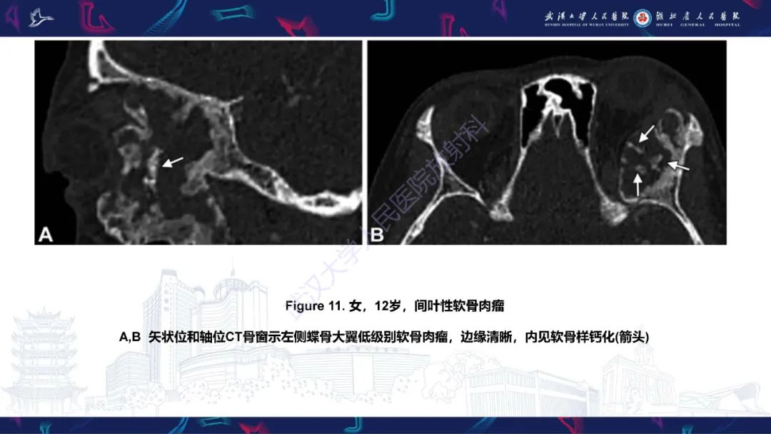 影像PPT - 【PPT】蝶骨大翼病变影像诊断-25