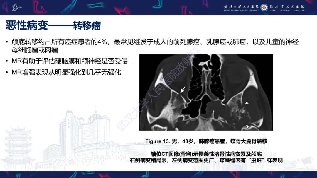 影像PPT - 【PPT】蝶骨大翼病变影像诊断-28