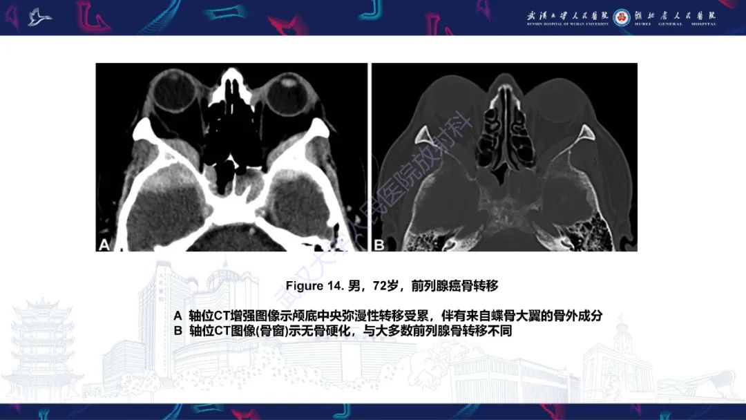 影像PPT - 【PPT】蝶骨大翼病变影像诊断-29