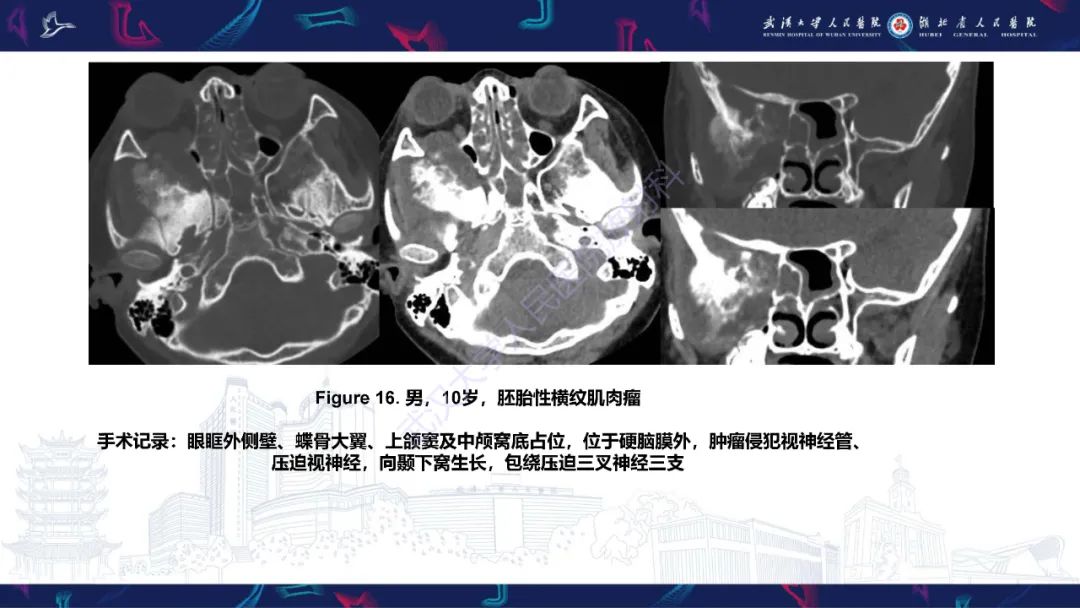 影像PPT - 【PPT】蝶骨大翼病变影像诊断-32