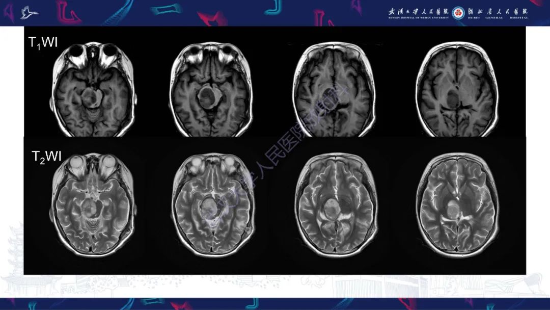 影像PPT - 【PPT】脑节细胞胶质瘤影像诊断-4