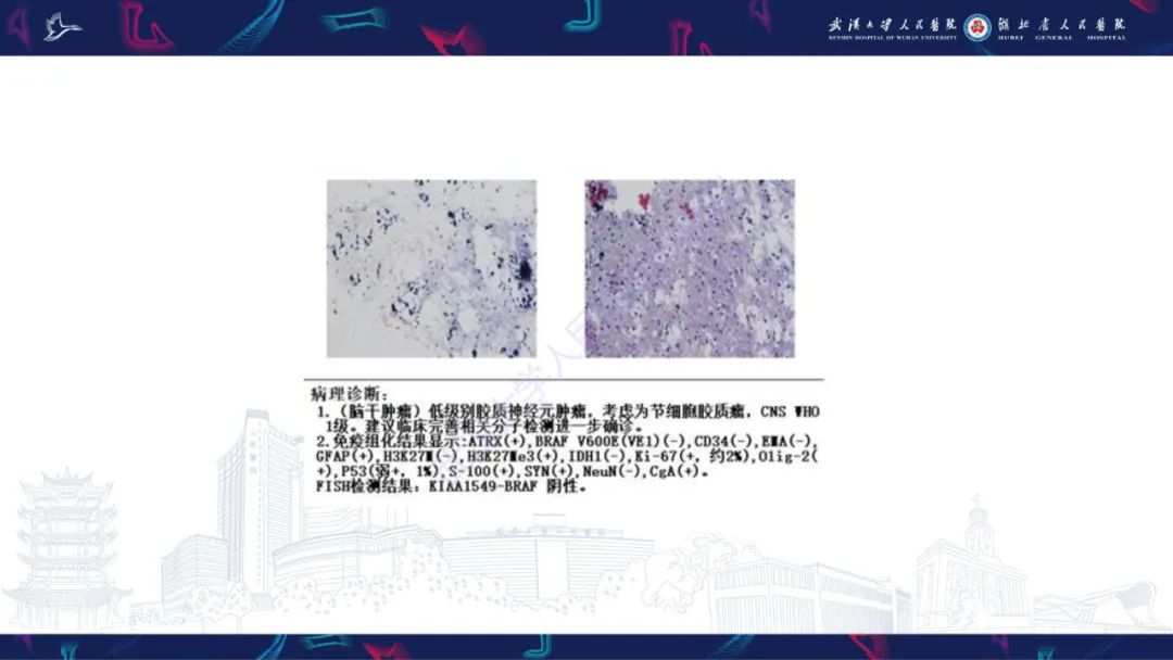 影像PPT - 【PPT】脑节细胞胶质瘤影像诊断-6