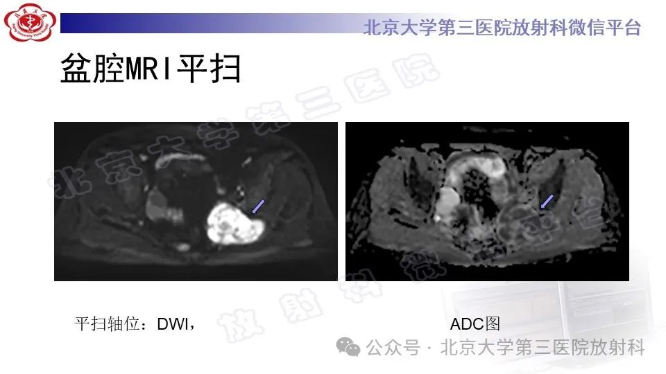影像PPT - 【PPT】盆腔孤立性纤维性肿瘤-7