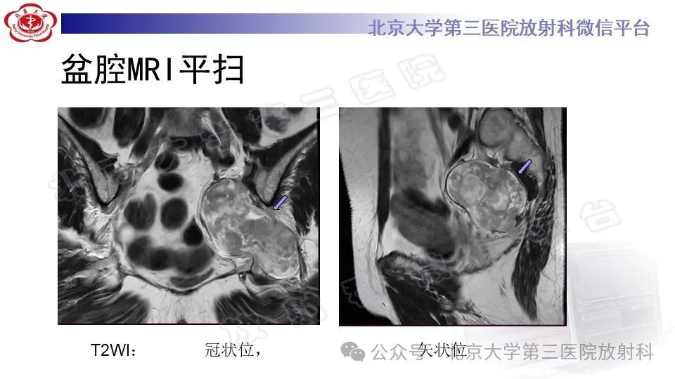 影像PPT - 【PPT】盆腔孤立性纤维性肿瘤-8