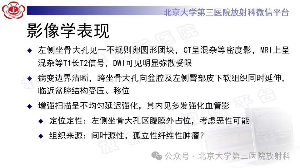 影像PPT - 【PPT】盆腔孤立性纤维性肿瘤-9