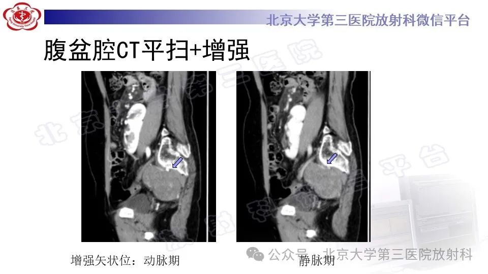 影像PPT - 【PPT】盆腔孤立性纤维性肿瘤-5