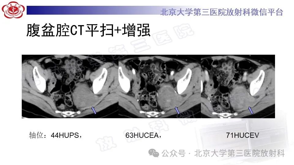 影像PPT - 【PPT】盆腔孤立性纤维性肿瘤-3