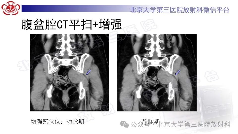 影像PPT - 【PPT】盆腔孤立性纤维性肿瘤-4