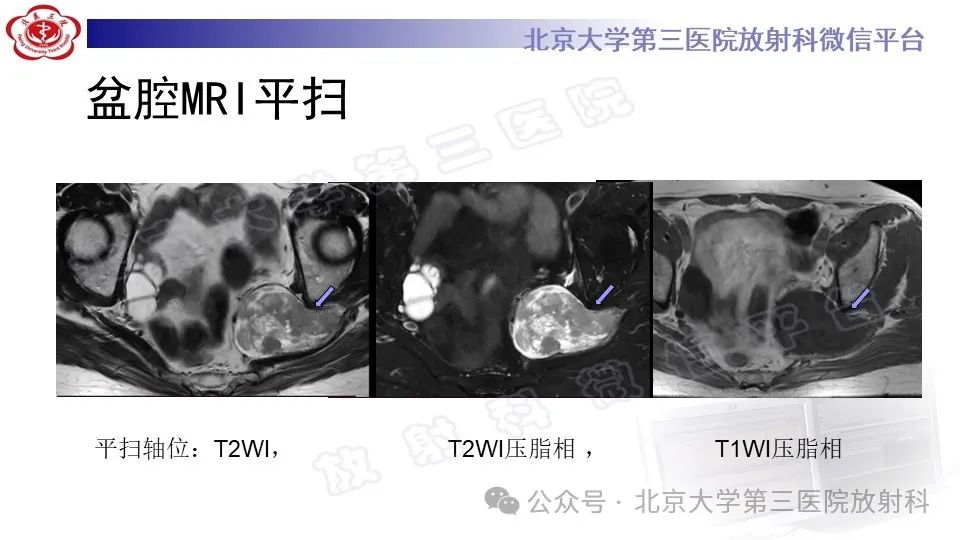 影像PPT - 【PPT】盆腔孤立性纤维性肿瘤-6