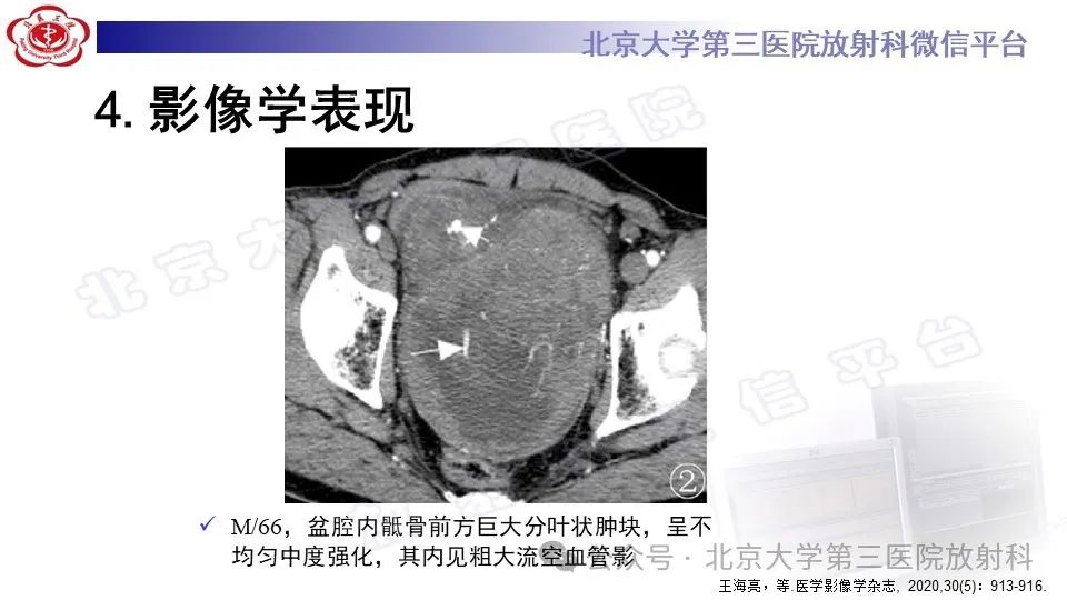 影像PPT - 【PPT】盆腔孤立性纤维性肿瘤-15