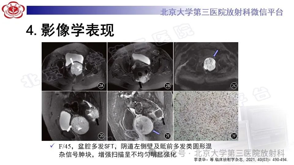 影像PPT - 【PPT】盆腔孤立性纤维性肿瘤-18
