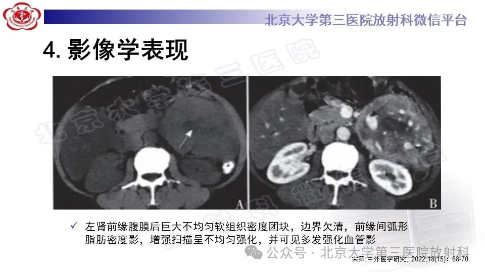 影像PPT - 【PPT】盆腔孤立性纤维性肿瘤-17
