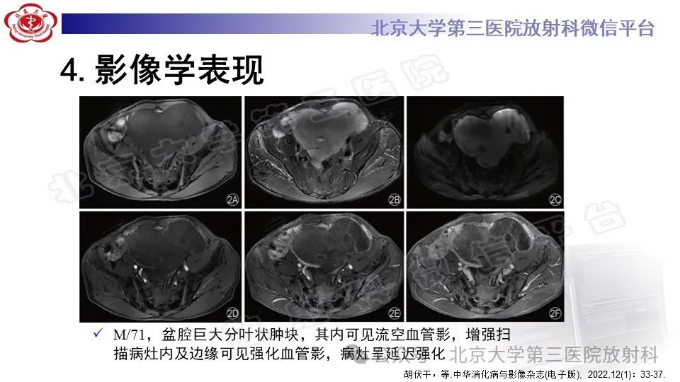 影像PPT - 【PPT】盆腔孤立性纤维性肿瘤-16