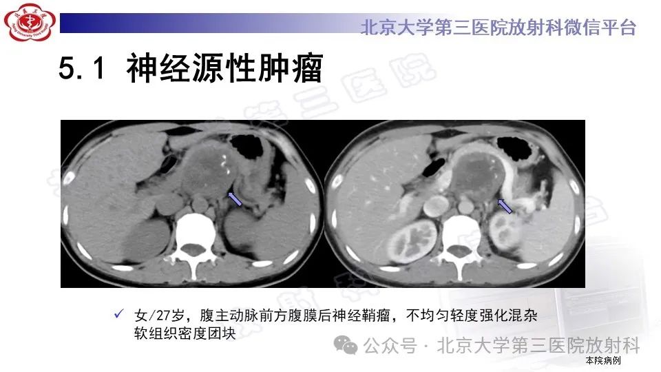 影像PPT - 【PPT】盆腔孤立性纤维性肿瘤-21