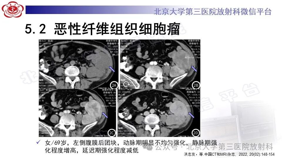 影像PPT - 【PPT】盆腔孤立性纤维性肿瘤-23