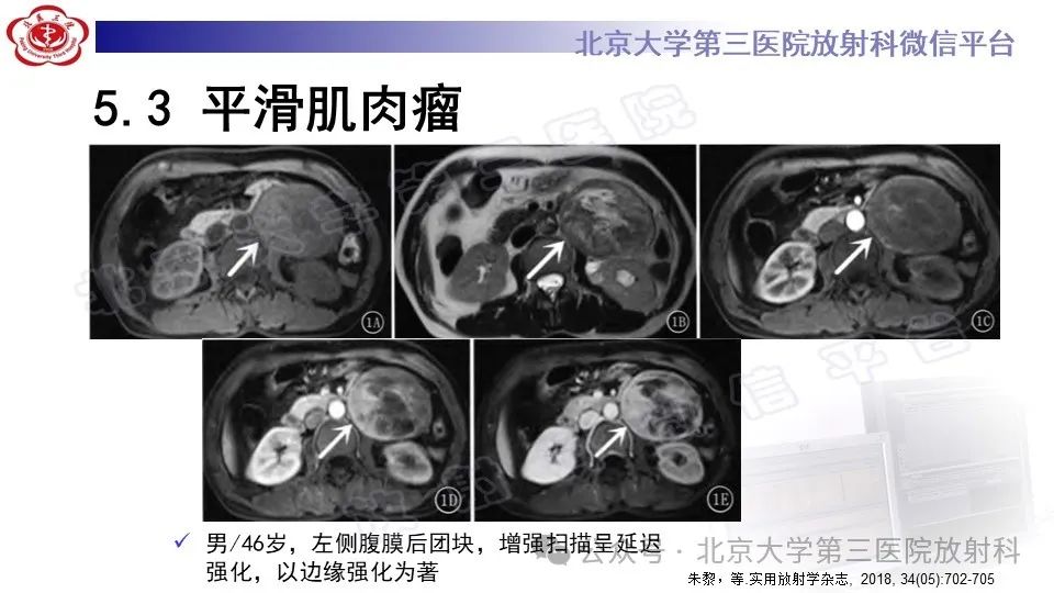 影像PPT - 【PPT】盆腔孤立性纤维性肿瘤-25