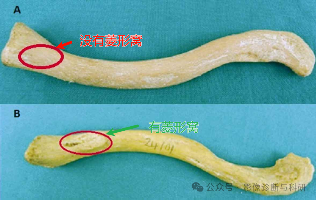 影像PPT - 锁骨菱形窝——这个结构不要再误认为骨质破坏-1