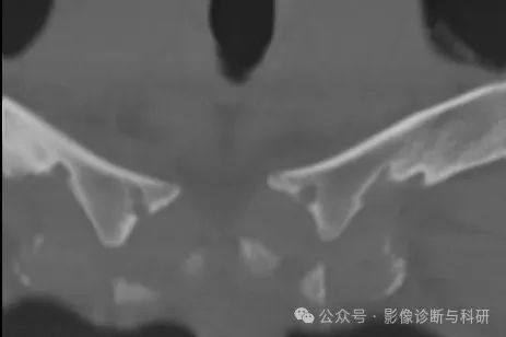 影像PPT - 锁骨菱形窝——这个结构不要再误认为骨质破坏-6