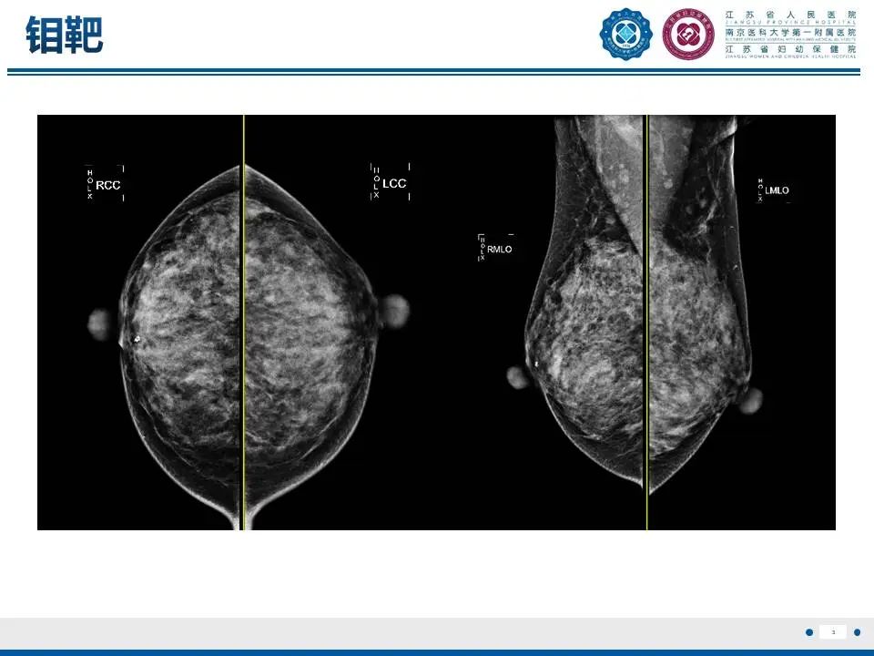 影像PPT - 【PPT】良性乳腺黏液囊肿样病变-4