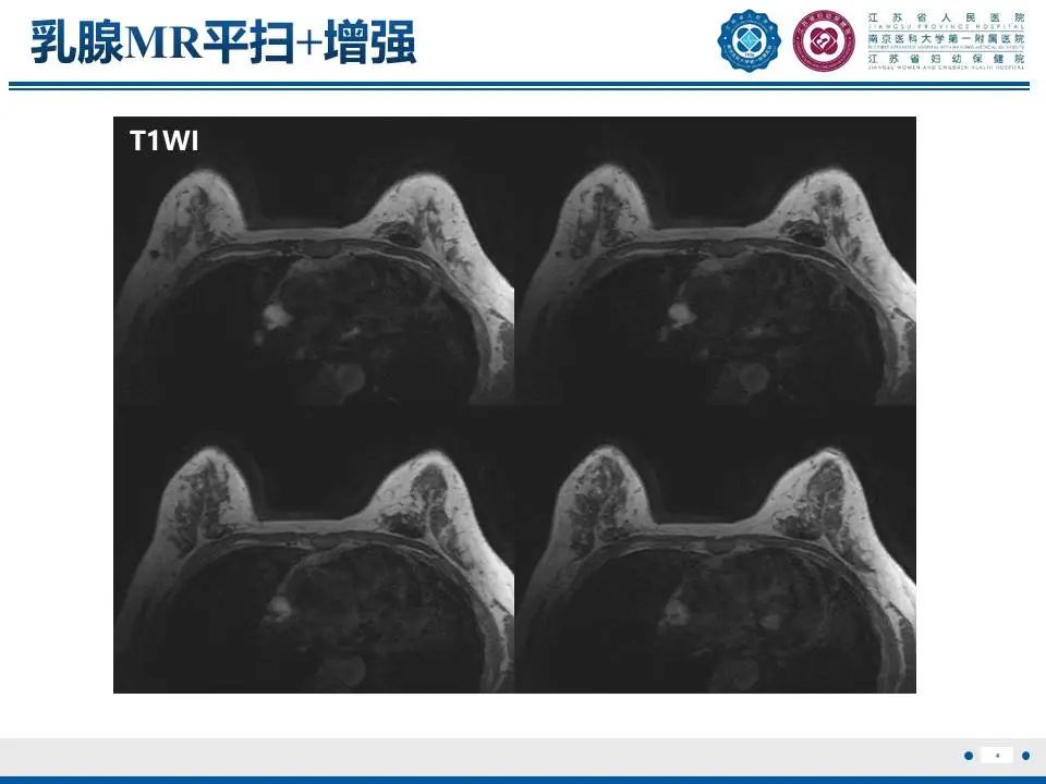 影像PPT - 【PPT】良性乳腺黏液囊肿样病变-5