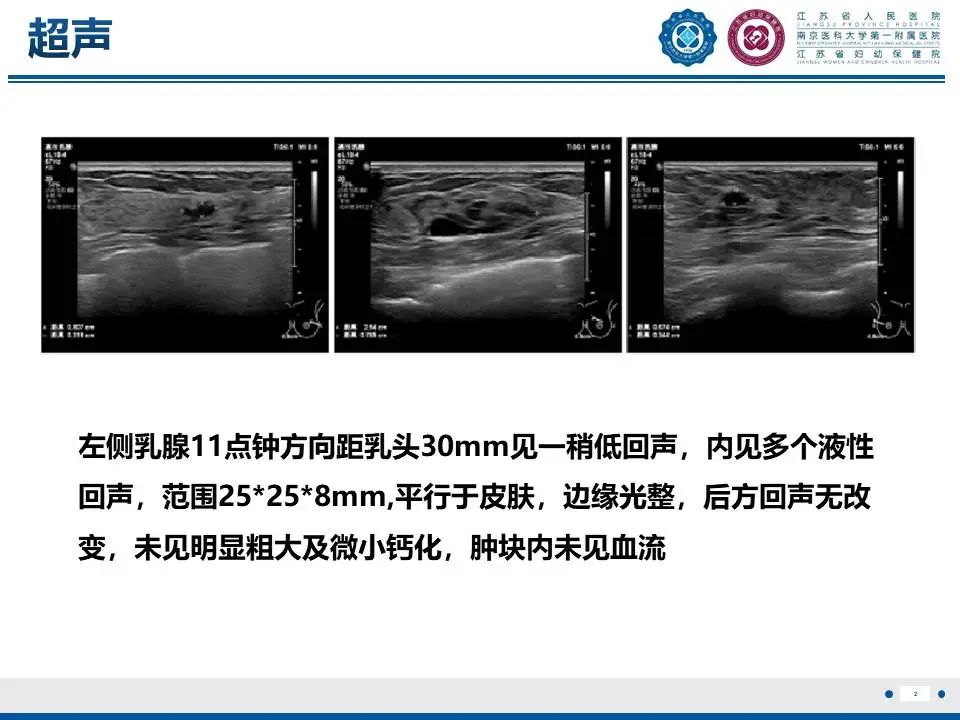 影像PPT - 【PPT】良性乳腺黏液囊肿样病变-3