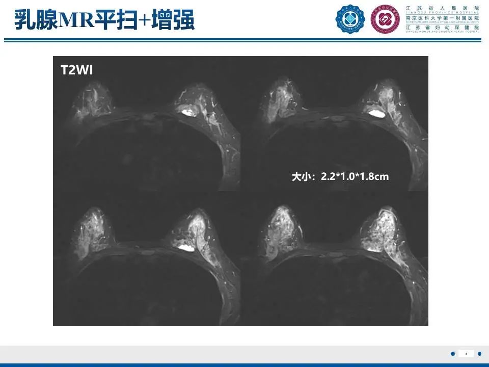 影像PPT - 【PPT】良性乳腺黏液囊肿样病变-6