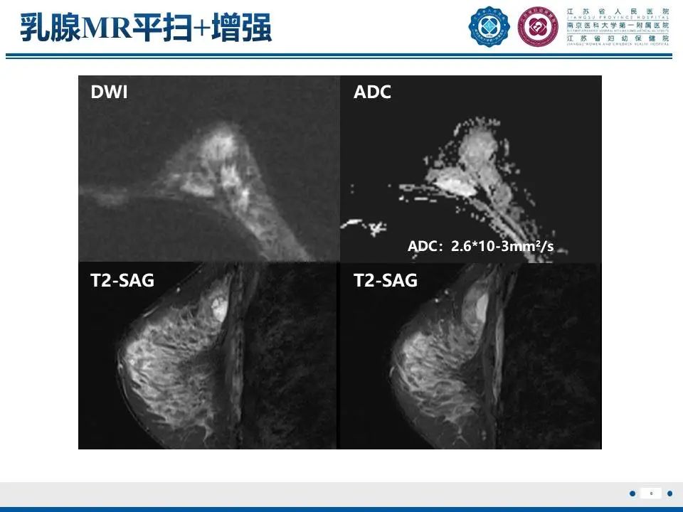 影像PPT - 【PPT】良性乳腺黏液囊肿样病变-7