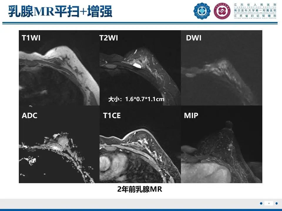 影像PPT - 【PPT】良性乳腺黏液囊肿样病变-9