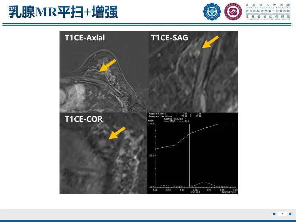 影像PPT - 【PPT】良性乳腺黏液囊肿样病变-8