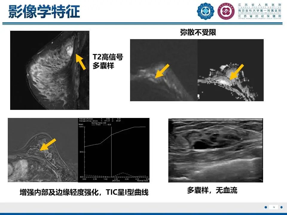 影像PPT - 【PPT】良性乳腺黏液囊肿样病变-13