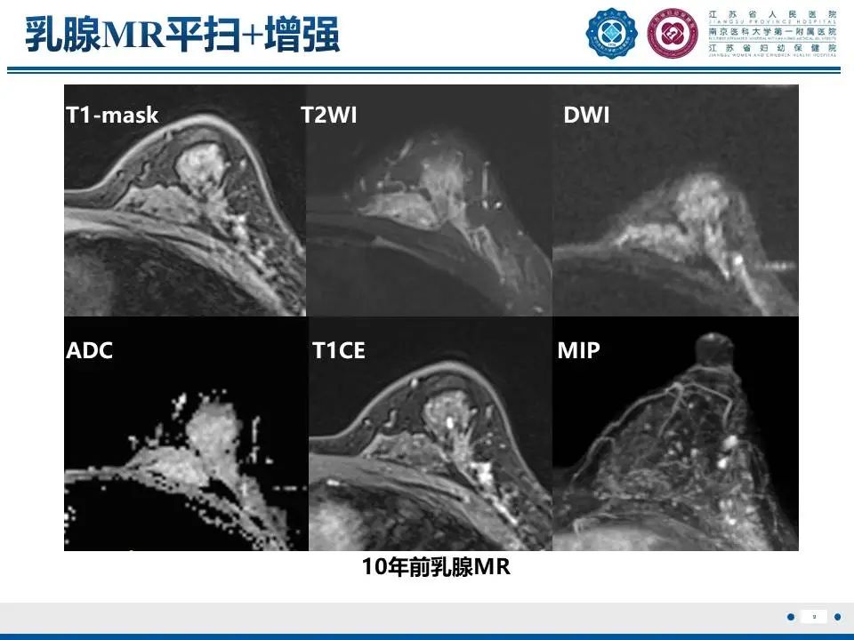 影像PPT - 【PPT】良性乳腺黏液囊肿样病变-10