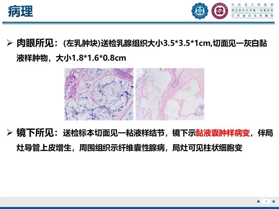 影像PPT - 【PPT】良性乳腺黏液囊肿样病变-17