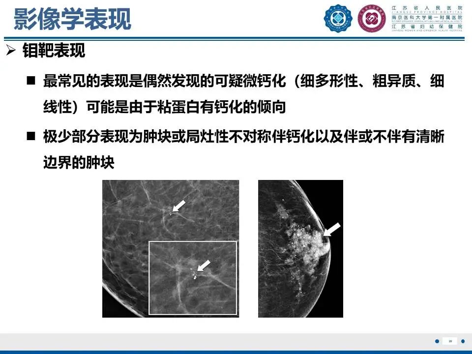 影像PPT - 【PPT】良性乳腺黏液囊肿样病变-21