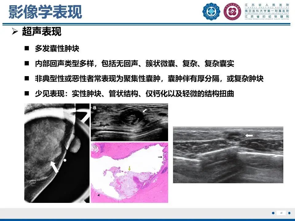 影像PPT - 【PPT】良性乳腺黏液囊肿样病变-22