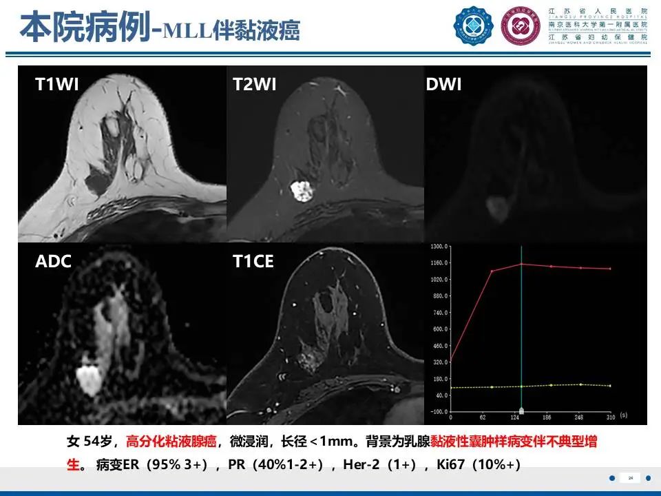 影像PPT - 【PPT】良性乳腺黏液囊肿样病变-25