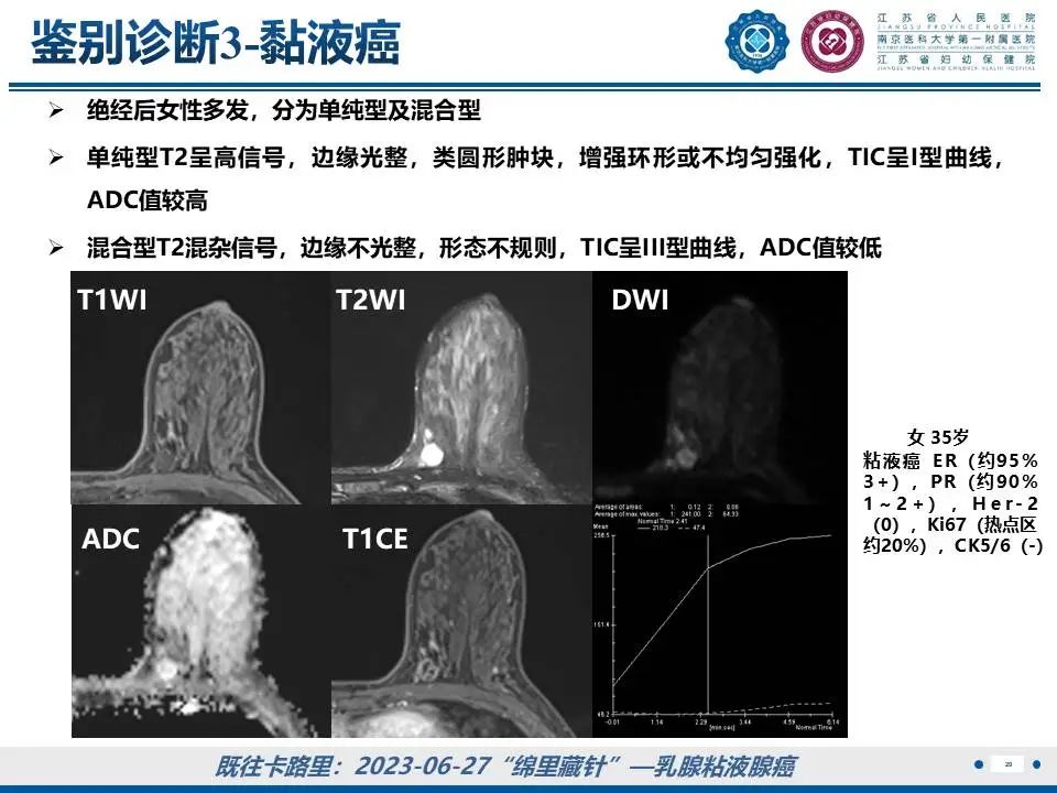 影像PPT - 【PPT】良性乳腺黏液囊肿样病变-30