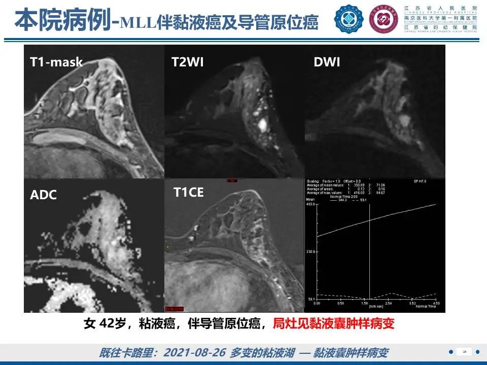 影像PPT - 【PPT】良性乳腺黏液囊肿样病变-26