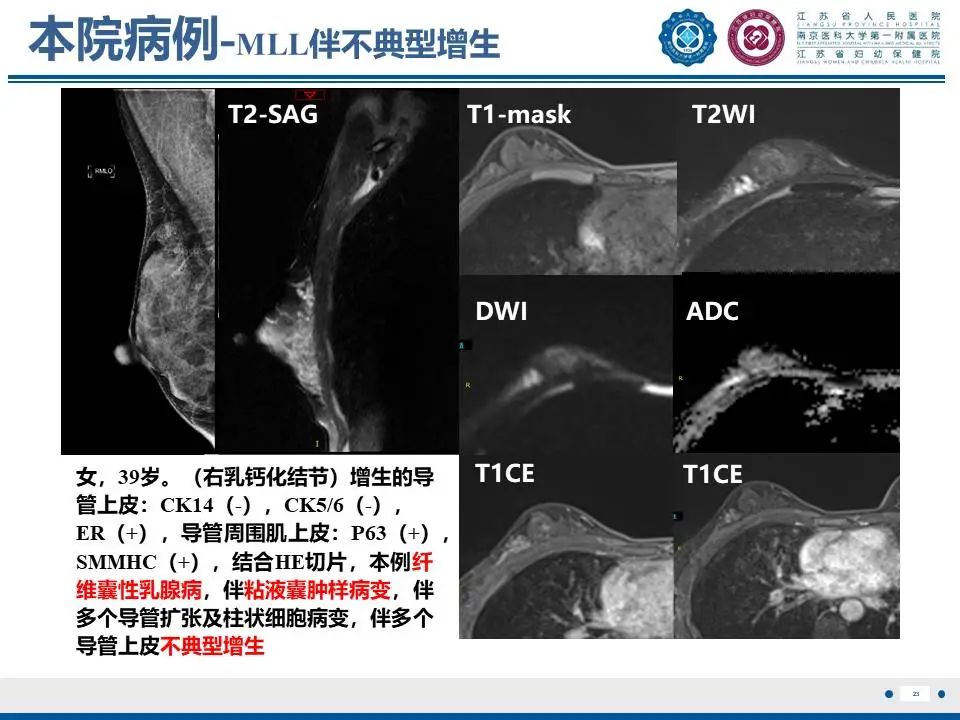 影像PPT - 【PPT】良性乳腺黏液囊肿样病变-24