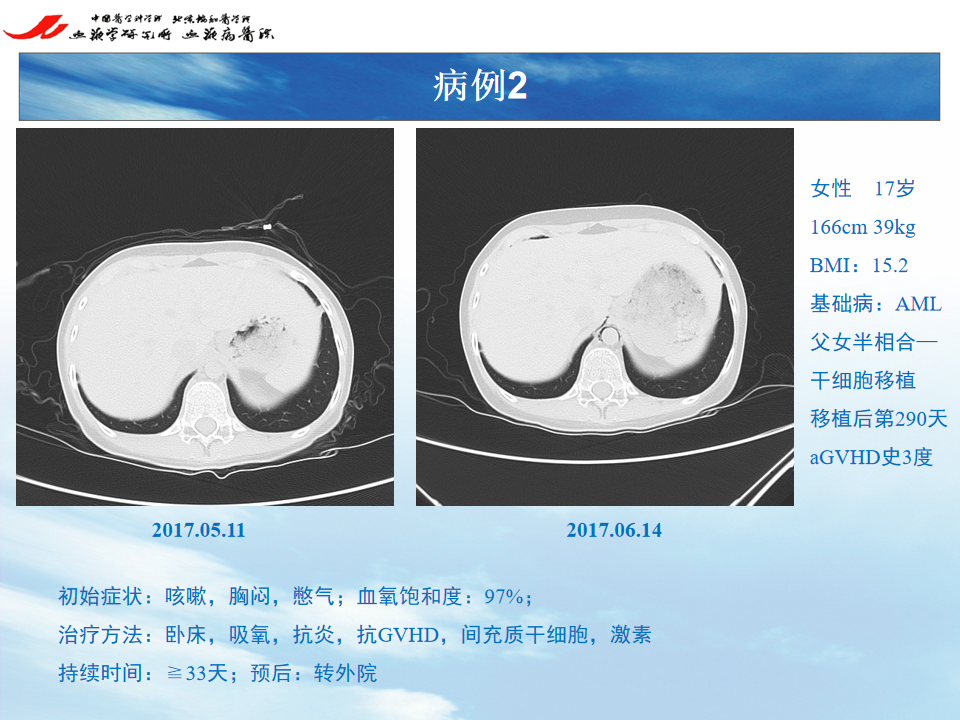 影像PPT - 【PPT】 空气渗漏综合症（ALS）-3