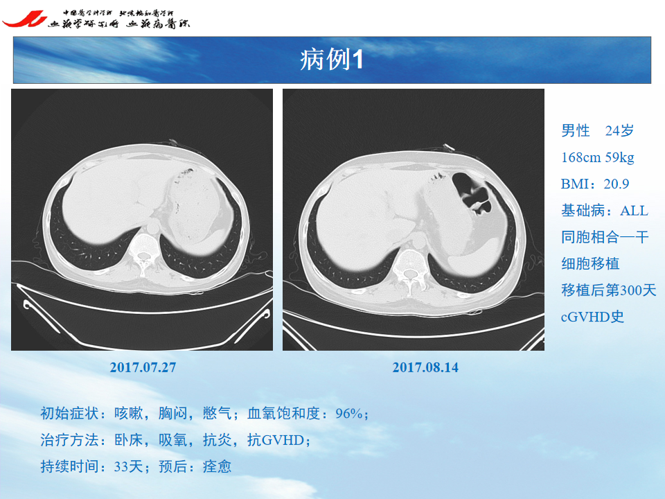 影像PPT - 【PPT】 空气渗漏综合症（ALS）-2