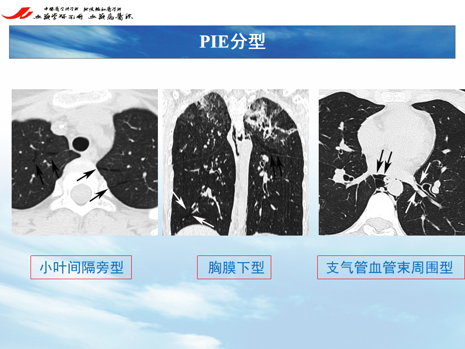 影像PPT - 【PPT】 空气渗漏综合症（ALS）-10