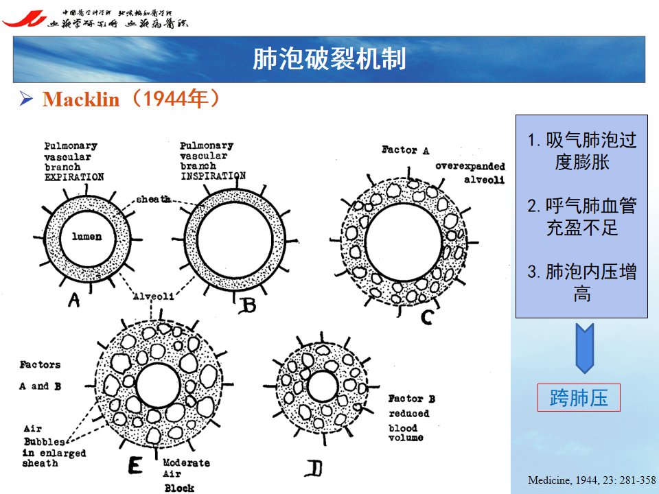 影像PPT - 【PPT】 空气渗漏综合症（ALS）-14