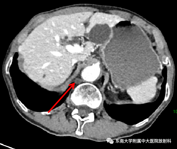 影像PPT - 【PPT】扩大乳糜池的影像表现及其鉴别诊断-1 影像PPT - 【PPT】扩大乳糜池的影像表现及其鉴别诊断-1